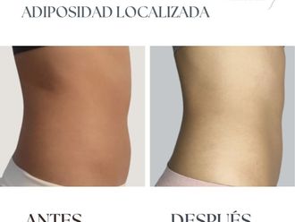 Mesoterapia antes y después - 845587