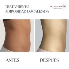 Mesoterapia - Dra Fanny Rosero Narváez
