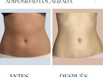 Mesoterapia antes y después - 845588