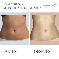 Mesoterapia - Dra Fanny Rosero Narváez
