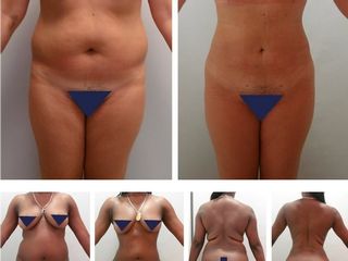Lipoescultura