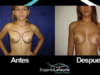 Mamoplastia de aumento