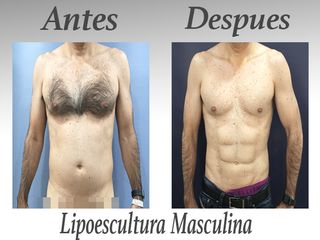 lipo masculina 3 meses