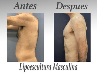 lipo masculina IV