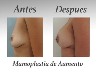 Mamoplastia de aumento I