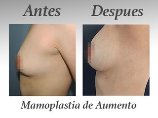 mamoplastia de aumento II