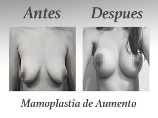 mamoplastia de aumento III