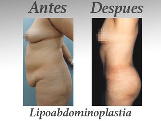 lipoabdominoplastia I
