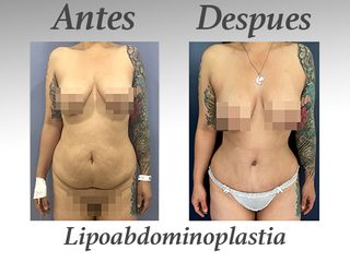 lipoabdominoplastia II