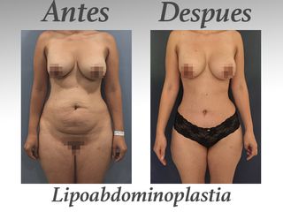 lipoabdominoplastia III