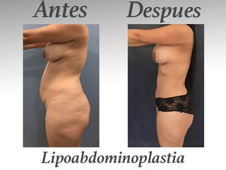 lipoabdominoplastia III - vista de perfil