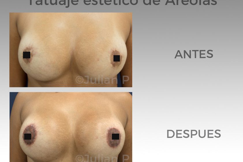 Borrar tatuajes antes y después - 576935