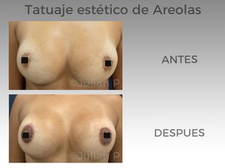 Tatuaje Estètico de areolas y pezón