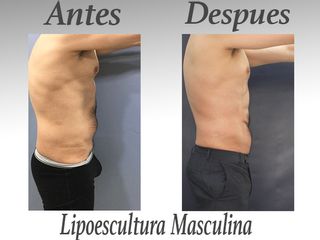 lipo masculina V