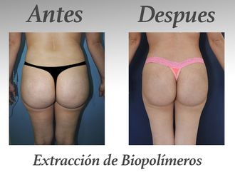 Retiro de Biopolímeros antes y después - 578744
