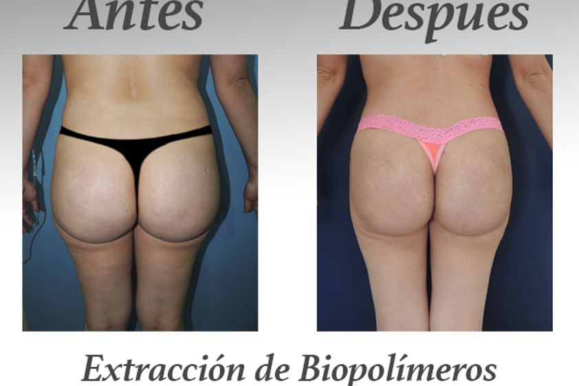 Retiro de Biopolímeros antes y después - 578744