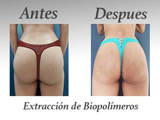 Retiro de Biopolímeros antes y después - 578745