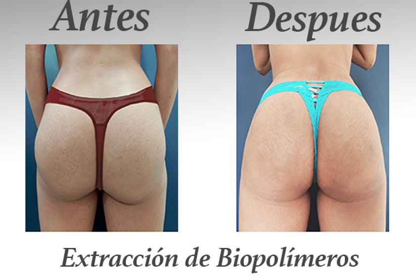 Retiro de Biopolímeros antes y después - 578745