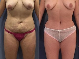 Antes y despues de lipoabdominoplastia