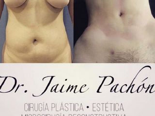 Antes y despues de lipoescultura