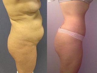Antes y despues de lipoabdominoplastia