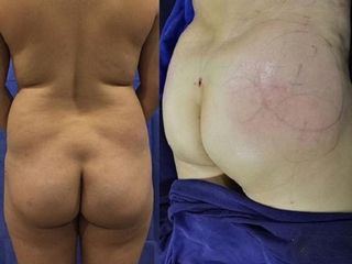 Antes y despues de Lipoescultura en región glúteos con lipoinyeccion
