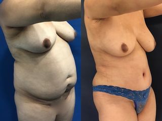 lipoabdominoplastia