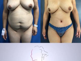 lipoabdominoplastia