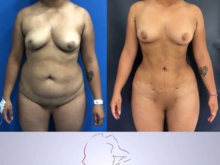 lipoescultura