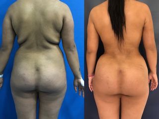 lipoescultura