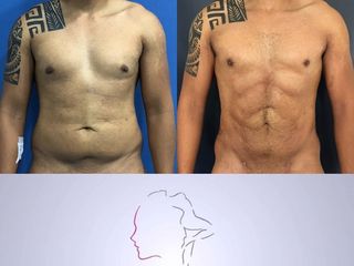 lipoescultura