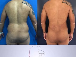 lipoescultura