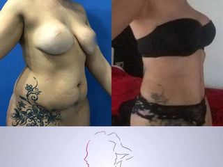 lipoabdominoplastia