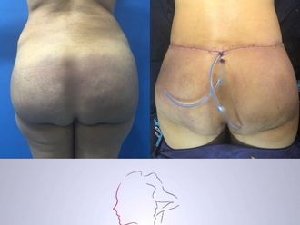 Retiro de Biopolímeros antes y después - 623378