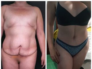 lipoabdominoplastia