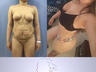 lipoabdominoplastia