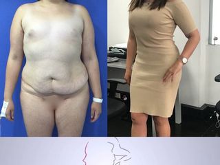 lipoabdominoplastia