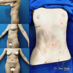 Liposucción - Dr. Jaime Pachón
