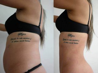 Hidro Lipólisis Antes y Después )