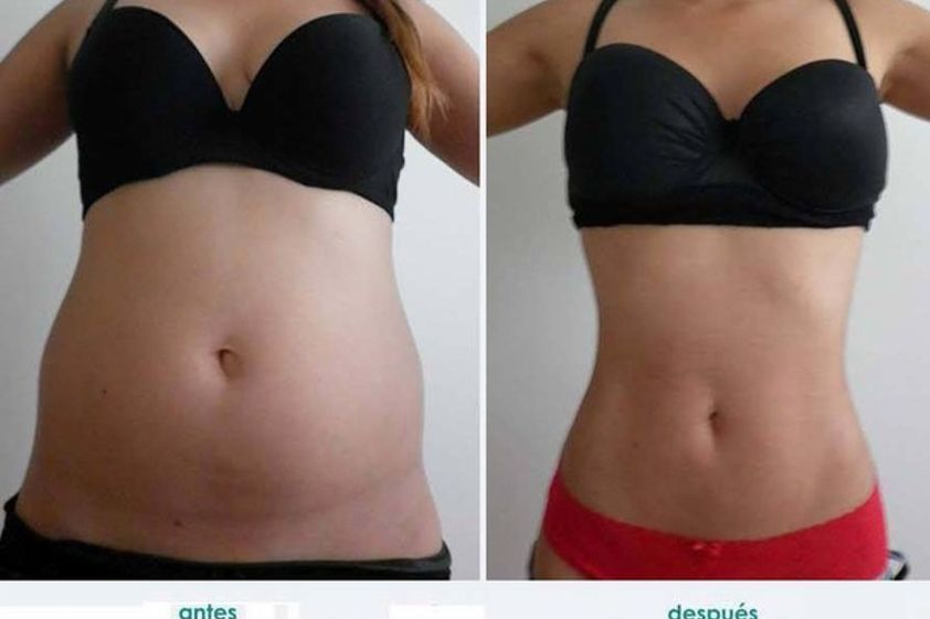 Tratamientos para adelgazar antes y después - 607968