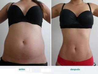 Hidro - Lipólisis ( Antes y Después )