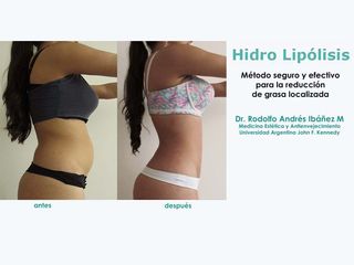 Hidro Lipólisis - Dr. Rodolfo Andres Ibañez