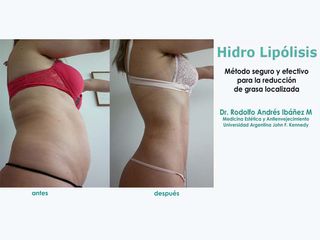 Hidro Lipólisis - Dr. Rodolfo Andres Ibañez