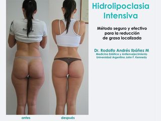 Hidrolipoclasia intensiva - Dr. Rodolfo Andres Ibañez