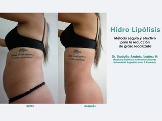 Hidro Lipólisis - Dr. Rodolfo Andres Ibañez