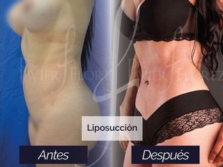 Lipoescultura - Dr. Flórez