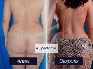 Lipoescultura- Lipectomía 