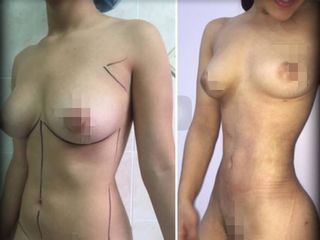Antes y despues de lipoescultura