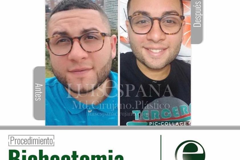 Bichectomía antes y después - 632720