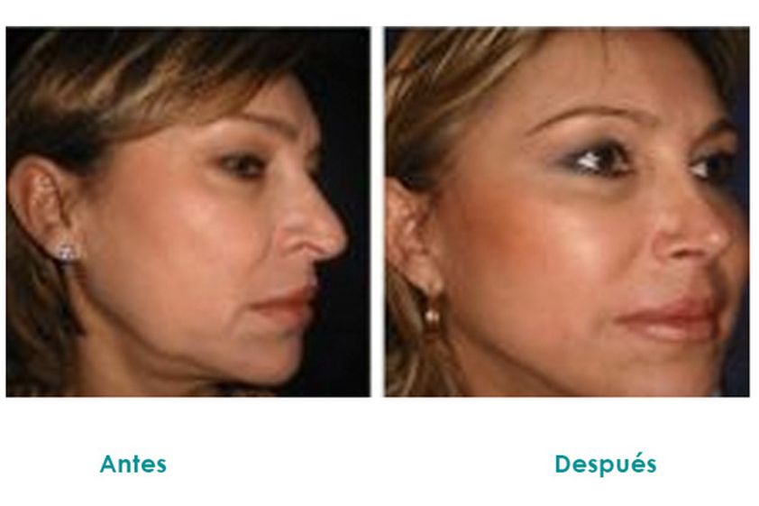 Lifting facial antes y después - 516429